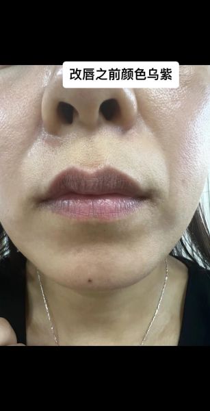 嘴唇颜色偏紫是什么原因_如何改善暗沉唇色