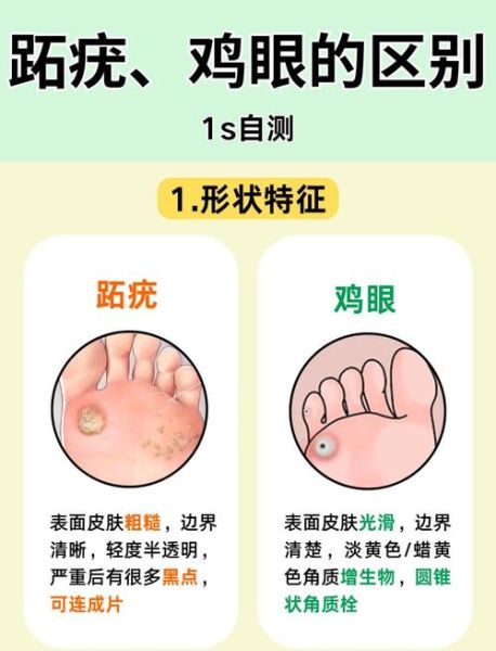 鸡眼运势_鸡眼长在脚底的运势含义