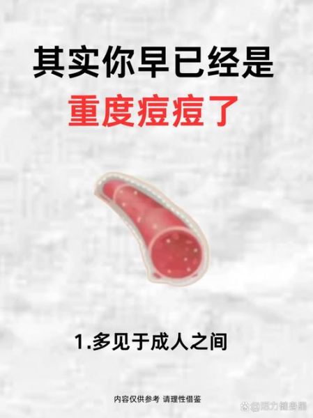 鼻头长痘财运会变差吗_如何破解鼻头长痘带来的破财征兆