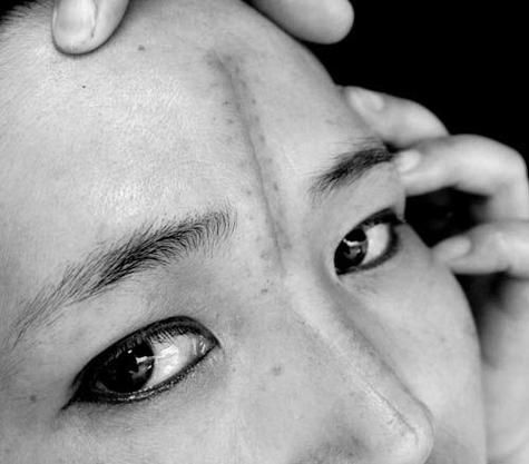 额头上有疤痕运势如何_额头疤痕会影响财运吗