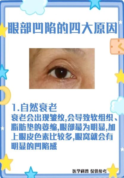 泪沟影响财运吗_泪沟和面相财运关系