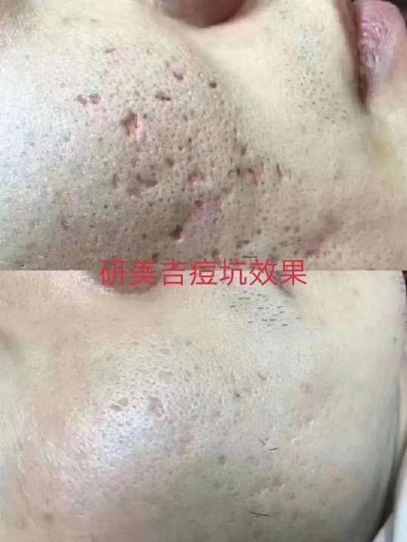 痘坑怎么修复_财运会变好吗