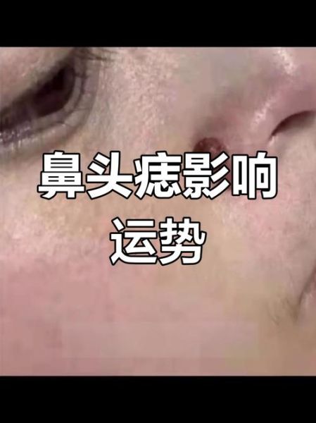 鼻头长痣财运_鼻头长痣好不好