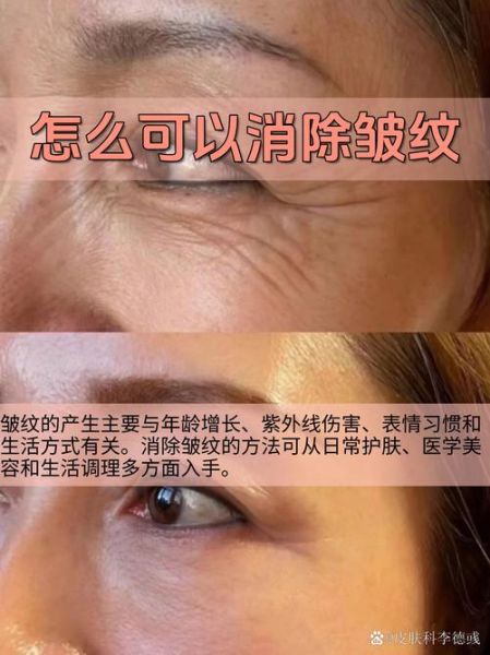 皱纹会影响财运吗_如何化解皱纹破财