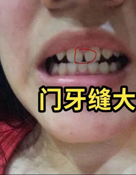 门牙运势代表什么_门牙有缝会影响财运吗