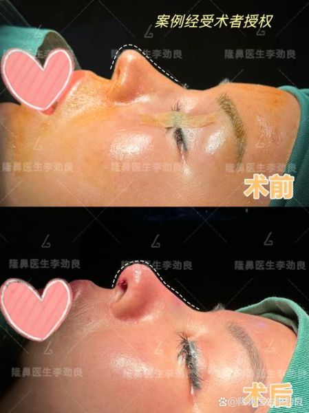 鼻子整形能改变财运吗_隆鼻后真的会招财吗
