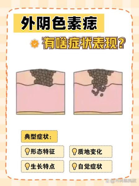 私处长痣好不好_私处长痣代表什么