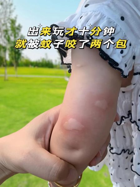 梦到被蚊子咬了好多包_周公解梦