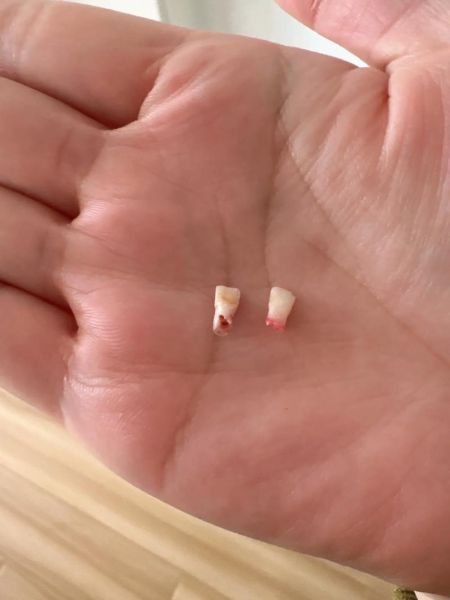 梦到掉了两颗牙_意味着什么
