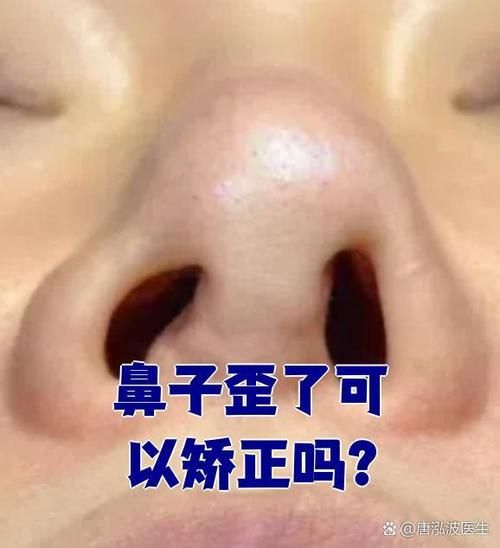 鼻子歪斜会影响财运吗_鼻子歪了怎么改运