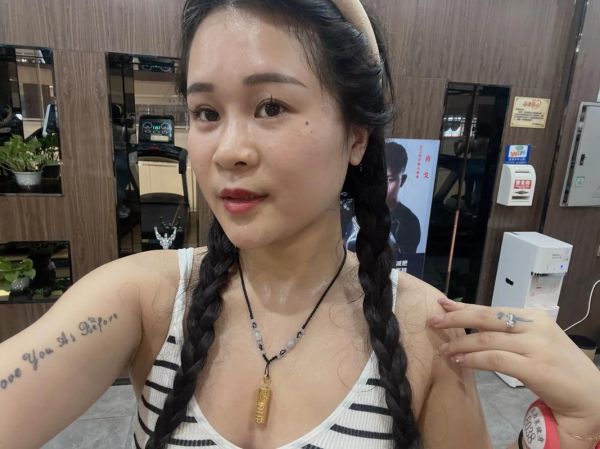 祛痣会影响运势吗_祛痣后运势变差怎么办