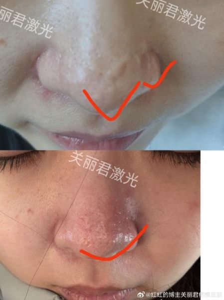 鼻头有疤影响财运吗_鼻头疤痕如何转运