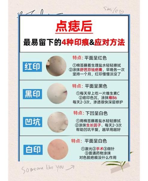 点痣会影响财运吗_点痣后财运变差怎么办