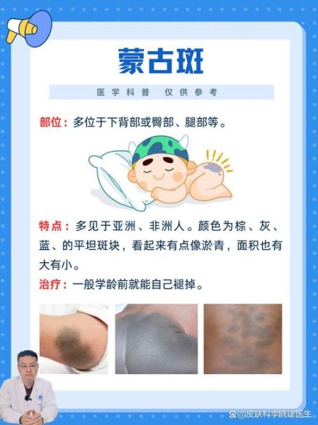 下颔胎记运势_下颔胎记命运好吗
