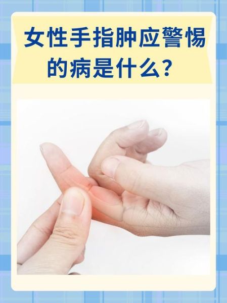 梦到手肿了_意味着什么