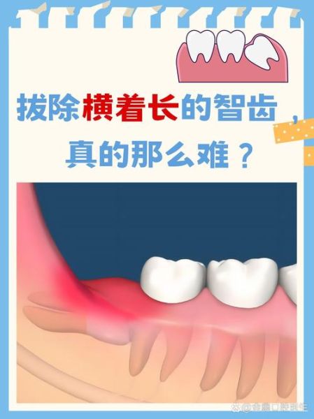 智齿运势_智齿真的影响运气吗