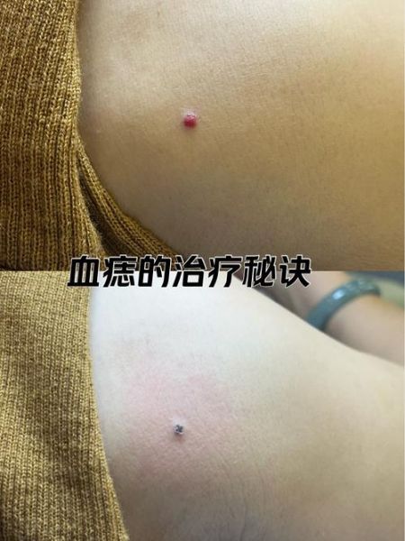 肩窝痣运势_肩窝有痣代表什么