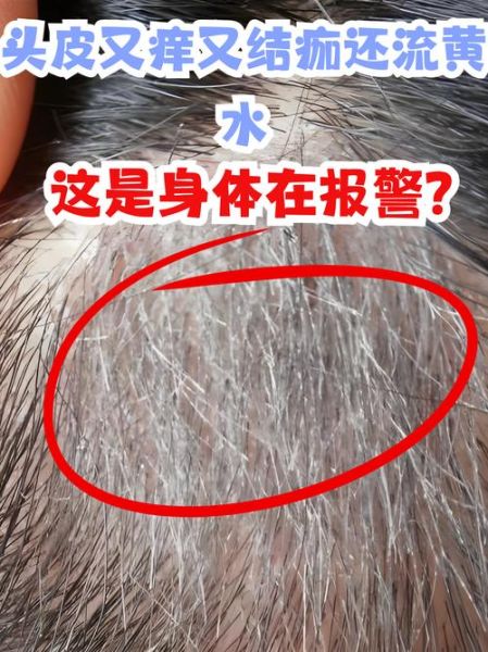 梦到头痒是怎么回事_梦见头皮痒预示什么