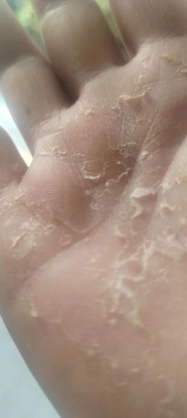 梦到手脱皮是什么意思_梦见手脱皮代表什么