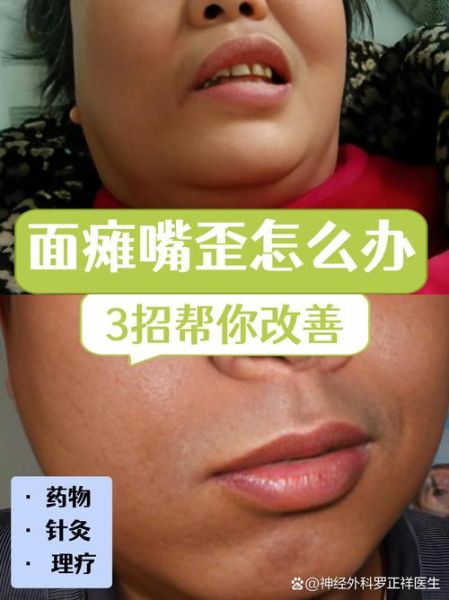 歪嘴运势是什么_歪嘴运势可信吗