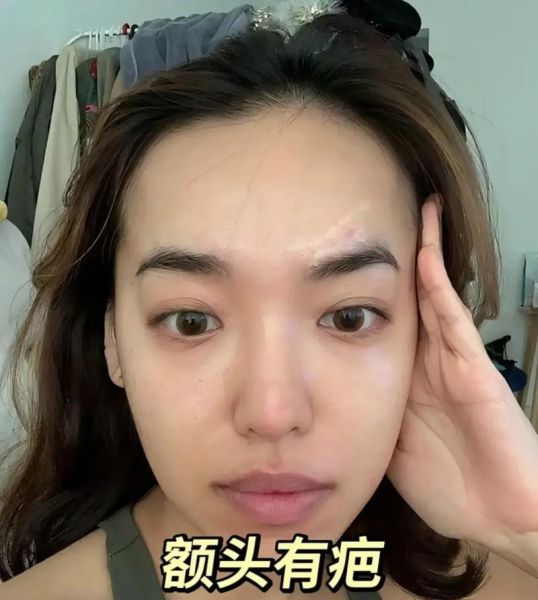 额头有疤运势_额头疤痕面相解读