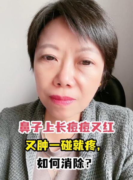 鼻梁长痘影响财运吗_如何化解