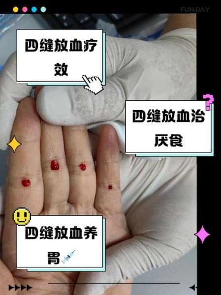 梦到被放血是什么意思_梦到被放血预示什么
