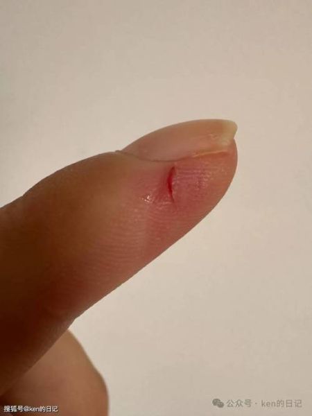 孕妇梦见手指流血是什么意思_孕期手指受伤梦境解析