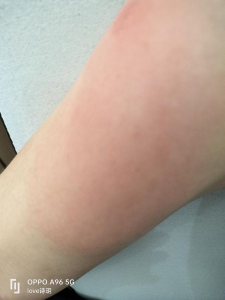梦到被蚊子咬出好多血_意味着什么