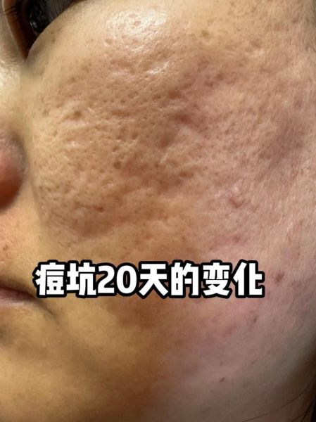 脸上痘坑多的男人运势_如何转运