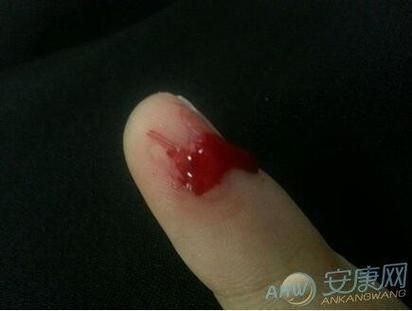 梦到自己流血不止_意味着什么