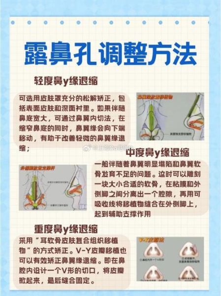 鼻孔外露怎么改善_鼻孔外露影响运势吗