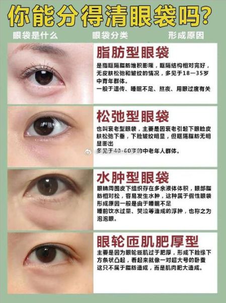 眼袋财运是真的吗_眼袋与财运的关系