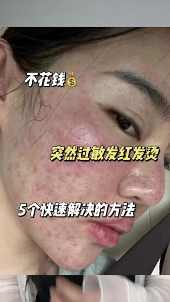 梦到脸上过敏_梦到脸上过敏预示什么