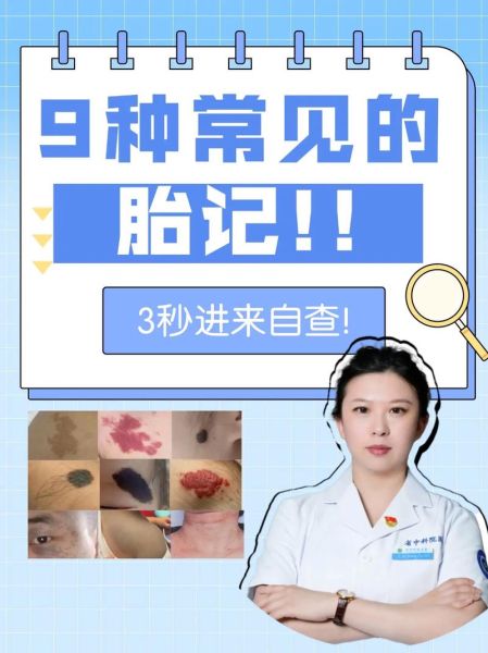 胎记影响运势吗_胎记位置与命运的关系