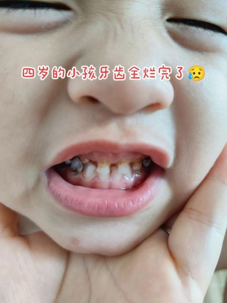 梦到牙齿烂了是什么意思_如何破解噩梦