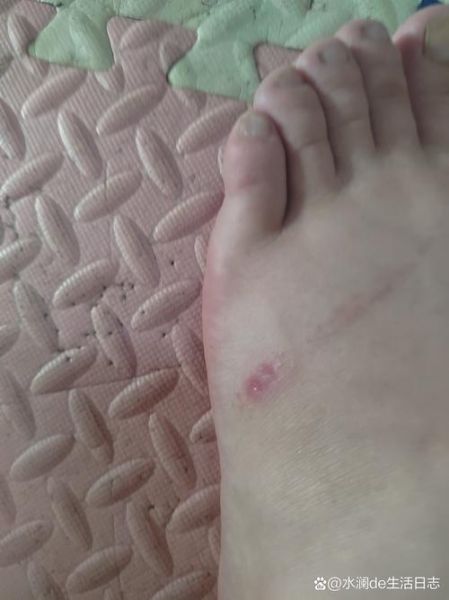 梦到脚破了_是什么意思