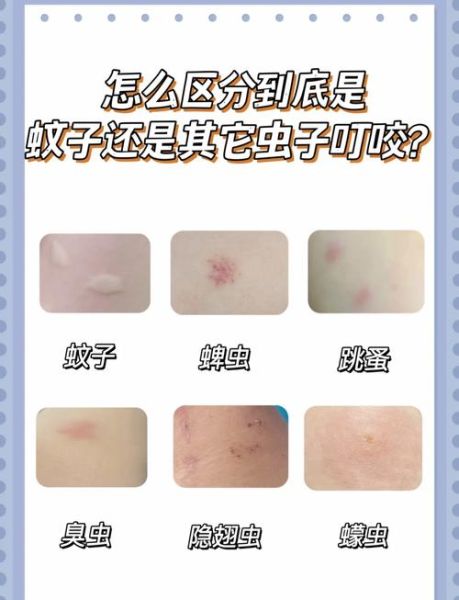梦到蚊子是什么意思_如何化解梦中蚊子叮咬