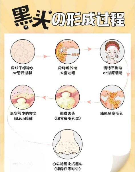 粉刺黑头怎么去除_粉刺黑头影响财运吗