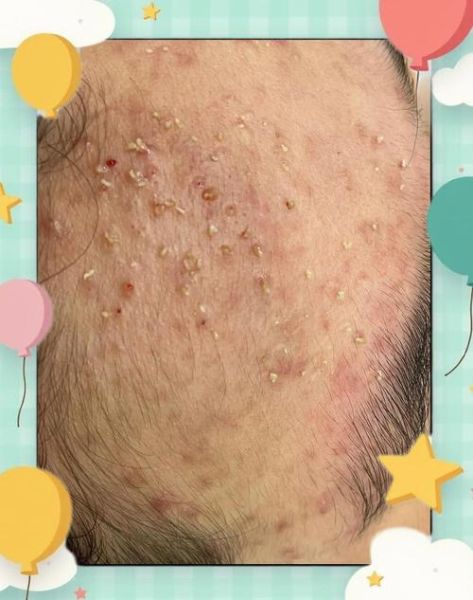 长粉刺的人财运会变差吗_如何转运