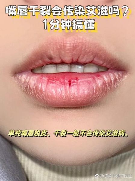 梦到嘴唇掉皮是什么意思_嘴唇脱皮梦境解析