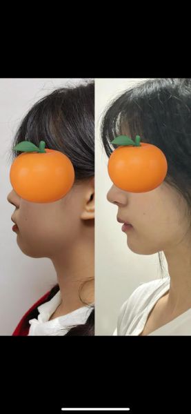 龅牙是财运吗_龅牙面相真的招财吗