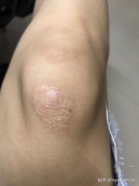 膝盖有疤运势_膝盖疤痕影响命运吗