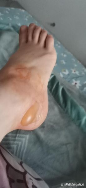梦到烫伤脚是什么意思_梦到烫伤脚预示什么