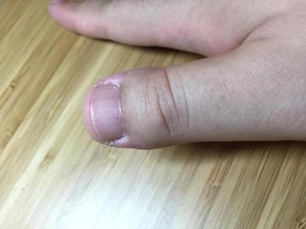 梦见手指断了_意味着什么