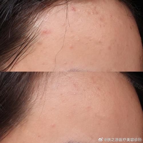 梦到青春痘是什么意思_青春痘梦境解析