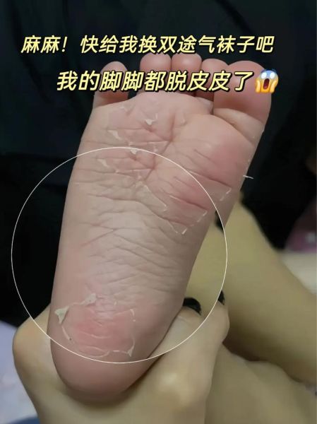 梦到脚上掉皮是什么意思_脚脱皮梦境解析