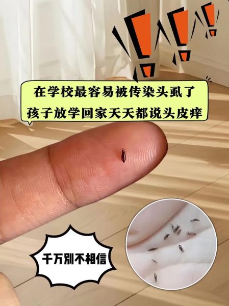 梦到捉虱子是什么意思_梦到捉虱子并捏死预示什么