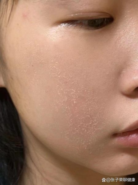 梦到脸上脱皮是什么意思_脸上脱皮梦境解析