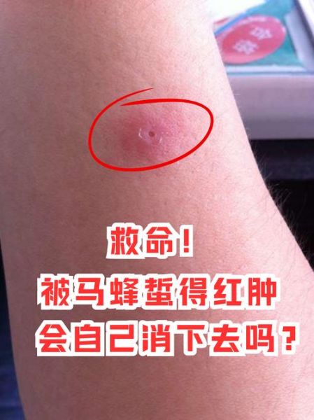 梦到被蜂蛰是什么意思_被蜂蛰梦境解析